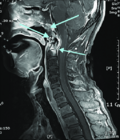 Thumbnail for File:Craniocervical-instability-CCI.png